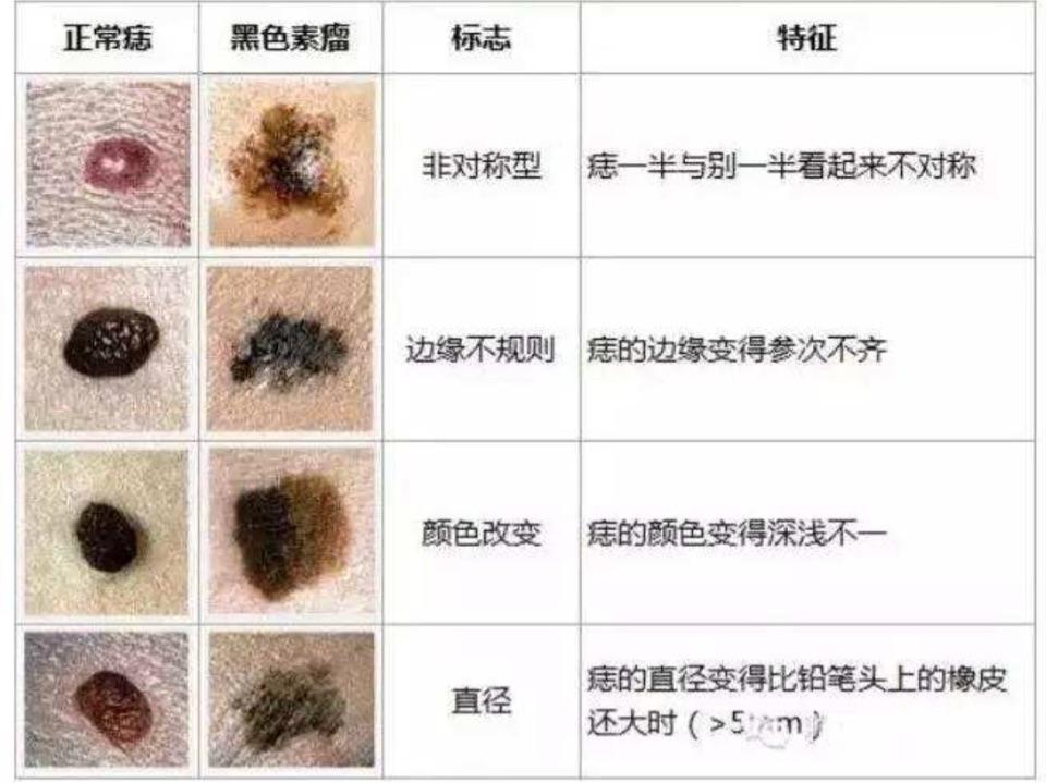 关于色素痣你了解多少