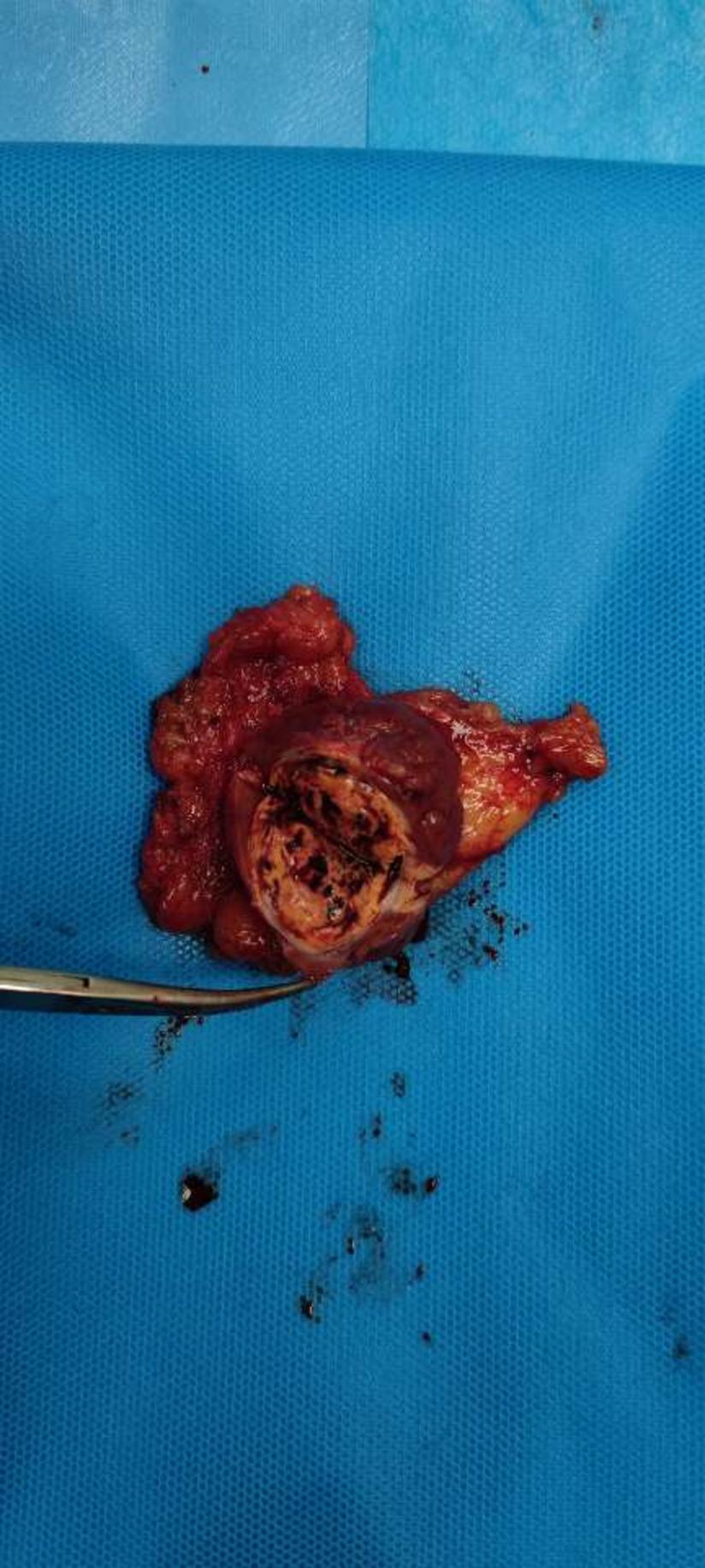 上周微医就诊的肾肿瘤患者本周已手术_高兴华医生文章_济南市中心医院