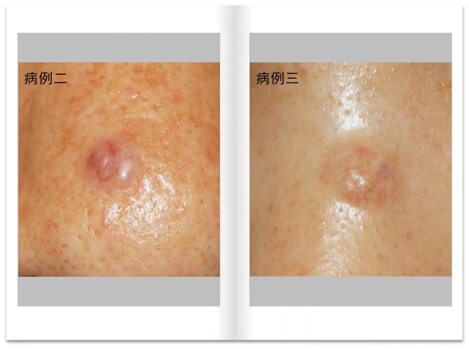 杨希川教授|8个病例解读基底细胞癌(bcc)诊断与鉴别