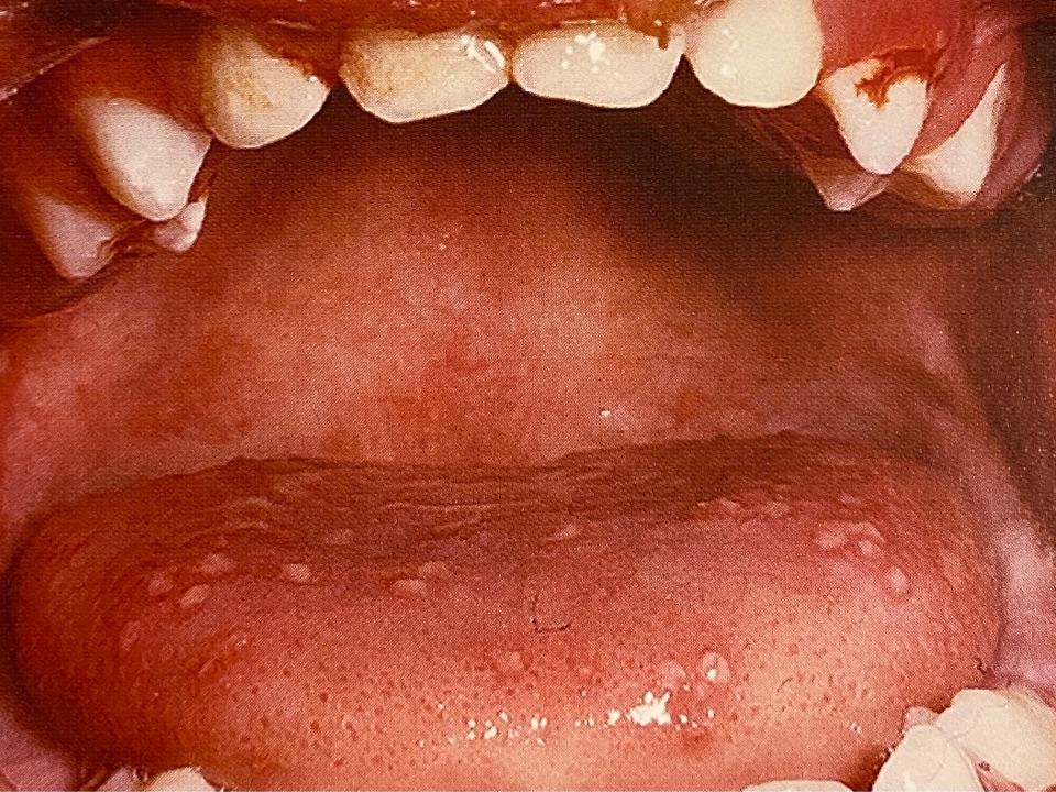 口腔疱疹的症状图片图片