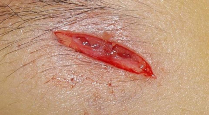 注意了:儿童磕碰伤家庭紧急处理方法都在这了!