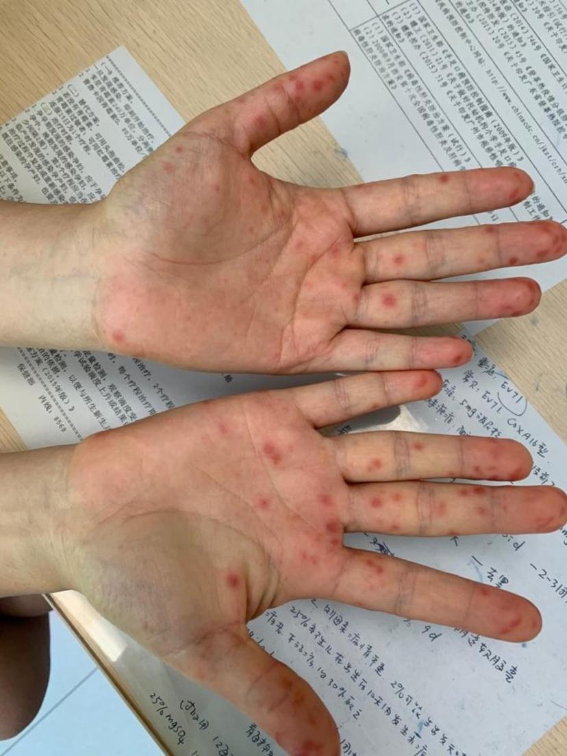 概念:手足口病是一种病毒性传染病,学龄前儿童易感,成人也可发病.