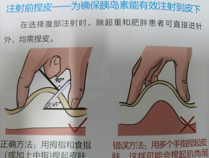 为确保胰岛素能有效注射到皮下提示:儿童和偏瘦成人采用45度角度进针