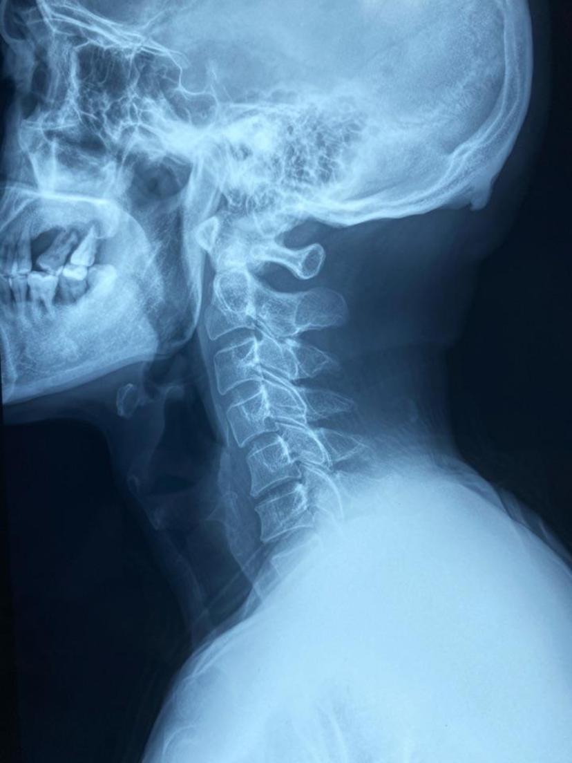 颈椎反弓术中完整取出压迫脊髓神经的椎间盘术后片子位置良好,颈椎