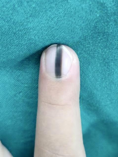 甲下黑色素瘤如何诊断