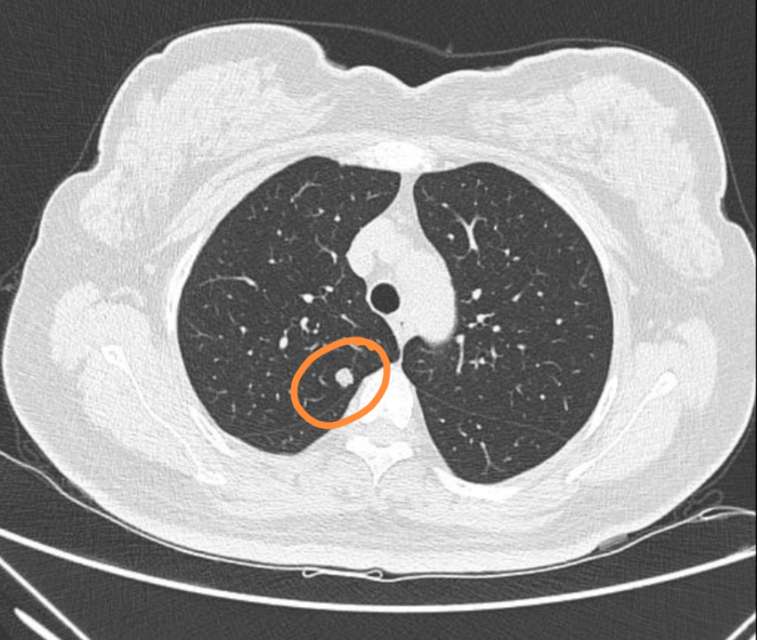 刘懿博士说肺癌五六九五体检出一厘米肺结节不像肺癌而像良性的