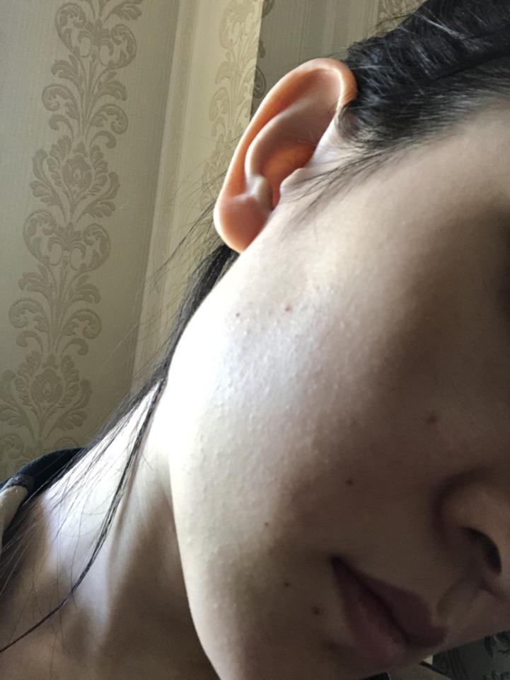 逆光疹不红不痒