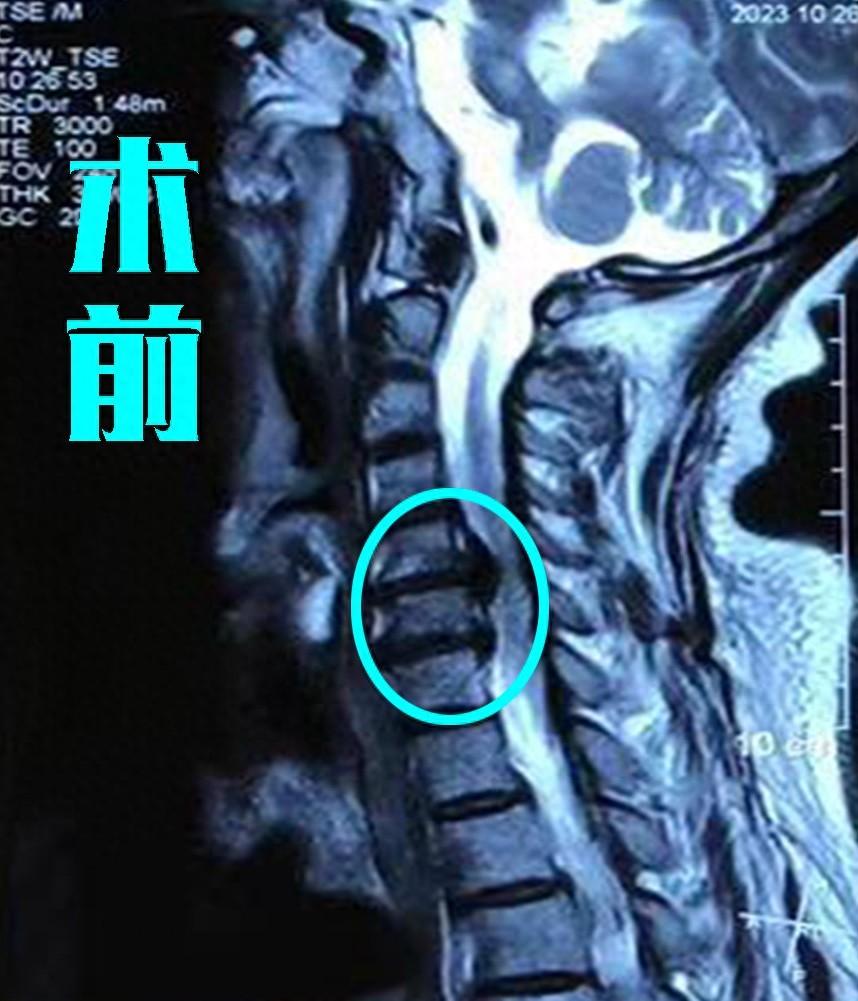 可能就光能看出颈椎间盘突出了两个节段,但是看到颈椎的ct片子后,就能