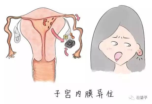 盆腔积液是怎么引起的?盆腔积液的原因