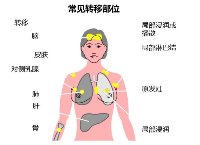 乳腺癌有哪些主要的转移途径