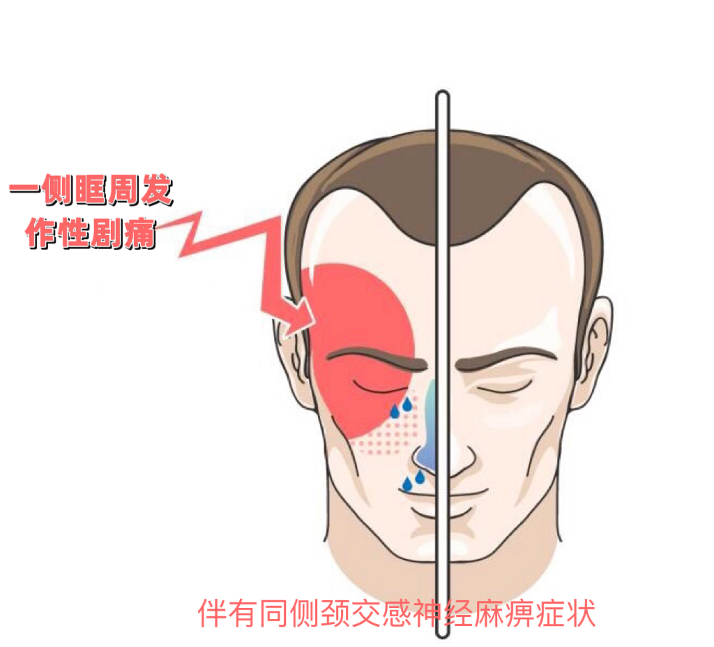 痛入脑髓的"丛集性头痛",如何拯救? - 微医(挂号网)