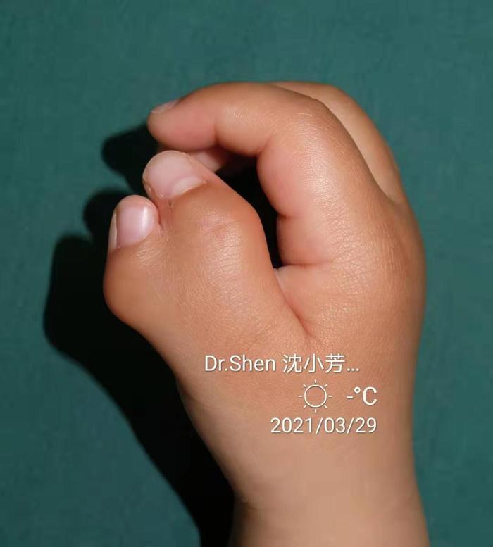 蟹钳多指 - 微医(挂号网)