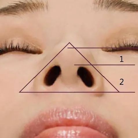 如果角度过大,即鼻小叶不够饱满,就会有鼻尖上翘的情况,严重时可能会