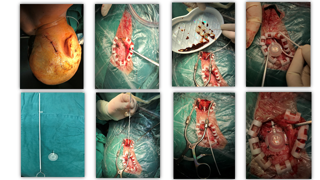 科普幻灯片ommaya储液囊在神经系统疾病中的应用