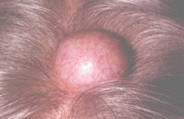 表皮囊肿是什么