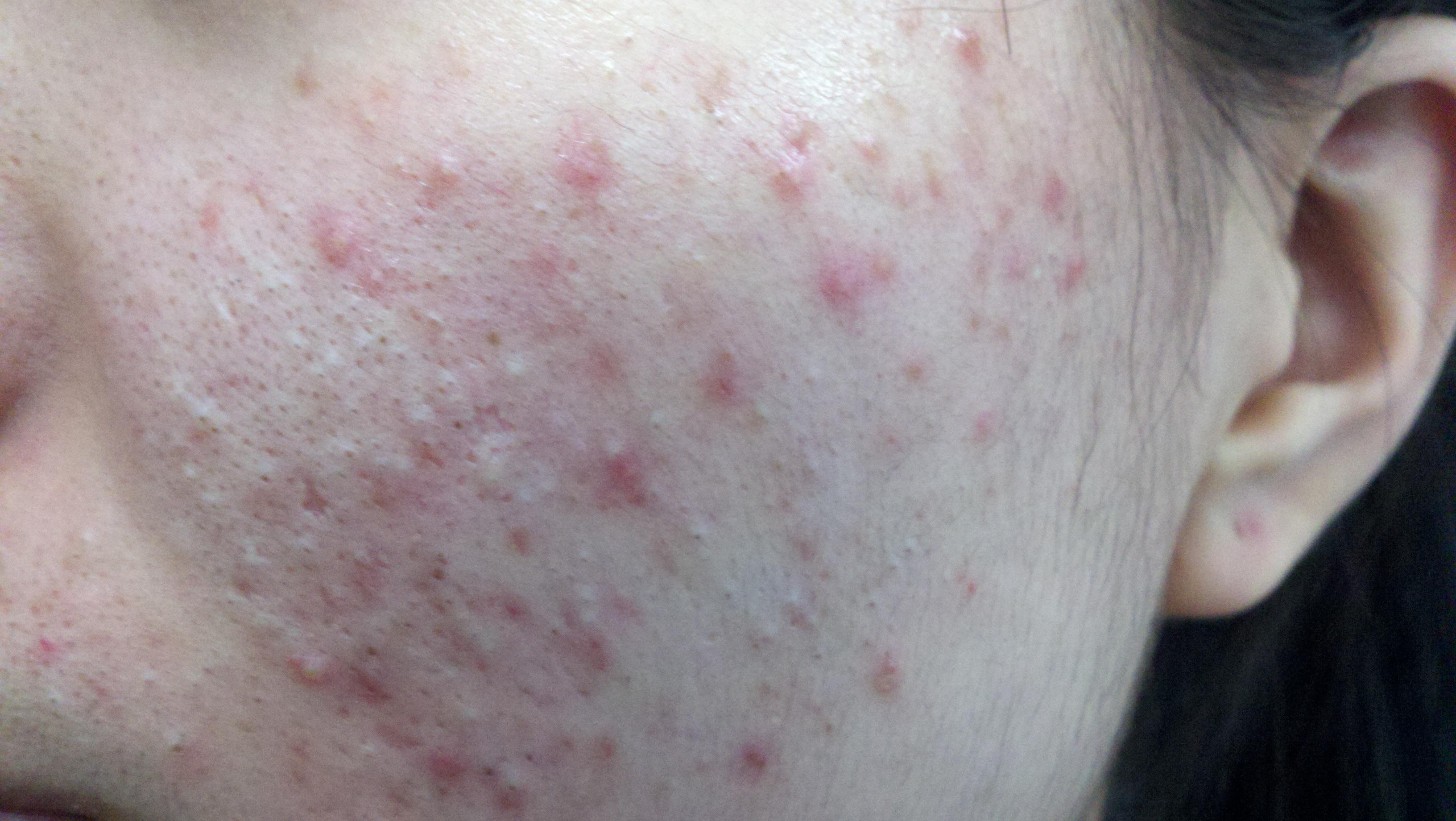 的时候,毛孔没有通畅,角化的不正常所造成的和皮脂腺过度分泌,痤疮丙