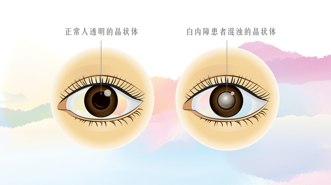 一不小心,光就伤到了眼_黄锦海医生文章_复旦大学附属眼耳鼻喉科医院