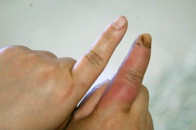 手被鱼刺扎了,会得一种少见病!