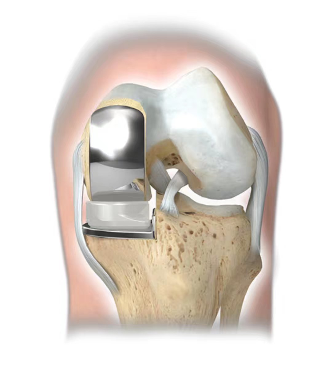周末时间,帮助兴城市人民医院完成这例膝关节单髁置换手术,同时这也是