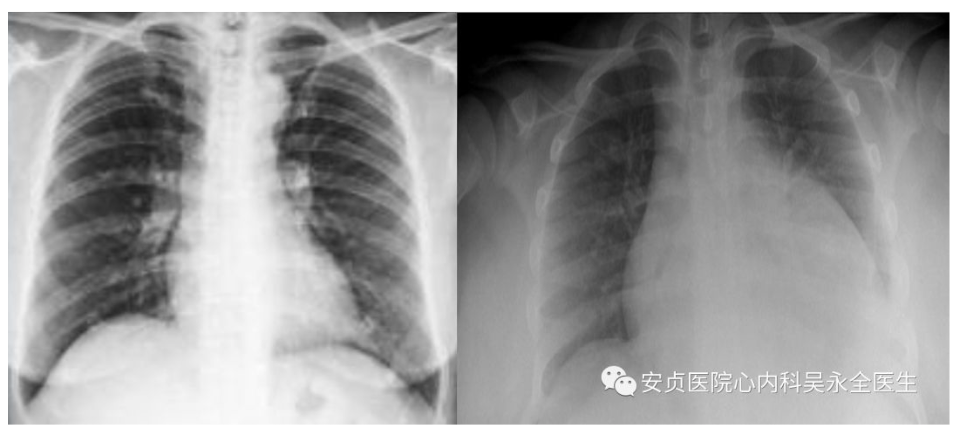 [CCC2013]从病例看CRT和CRTD在心力衰竭中的应用_扩张型心肌病_心力衰竭_CRT_CRTD_医脉通