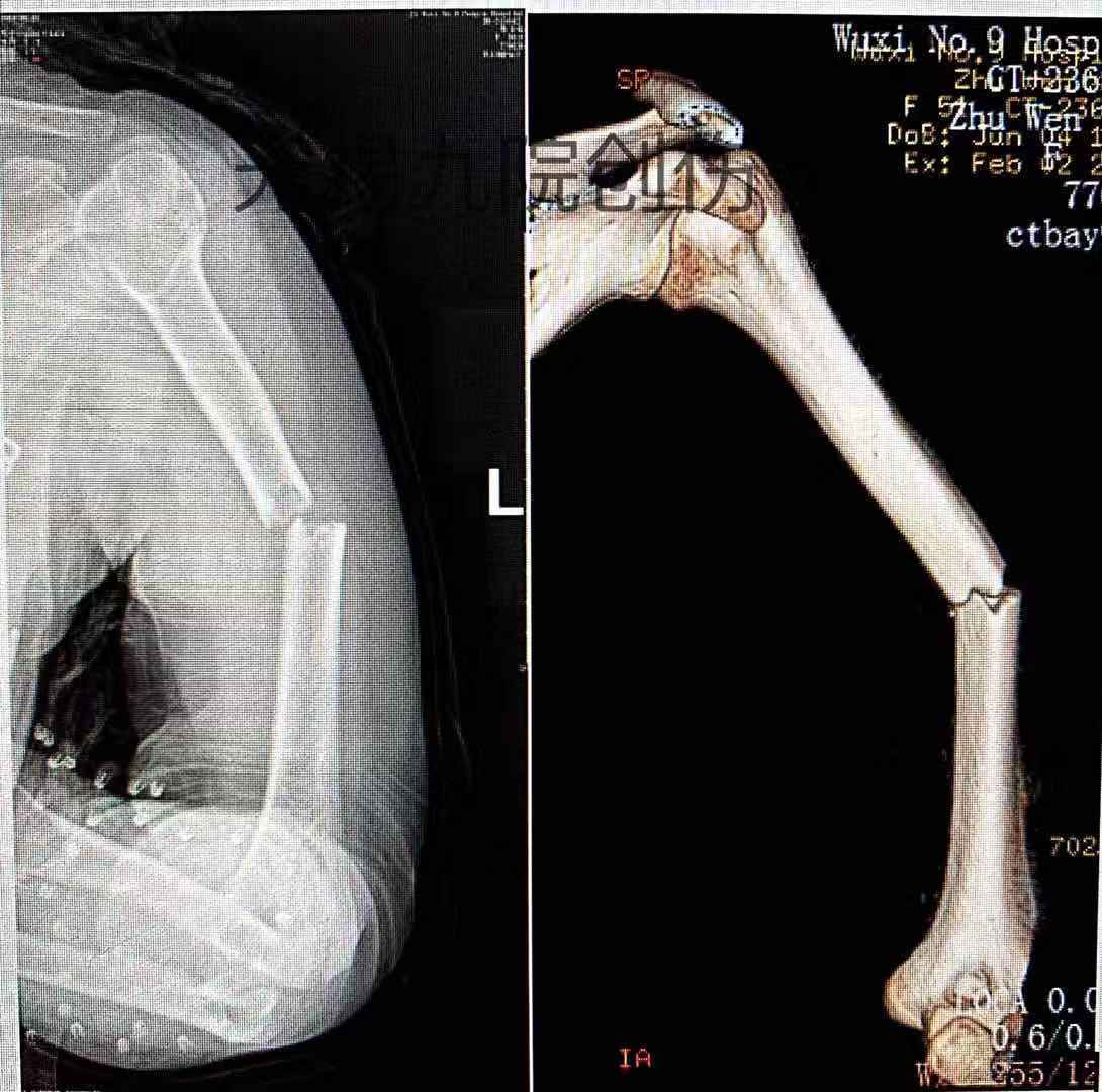 肱骨干骨折x线图片