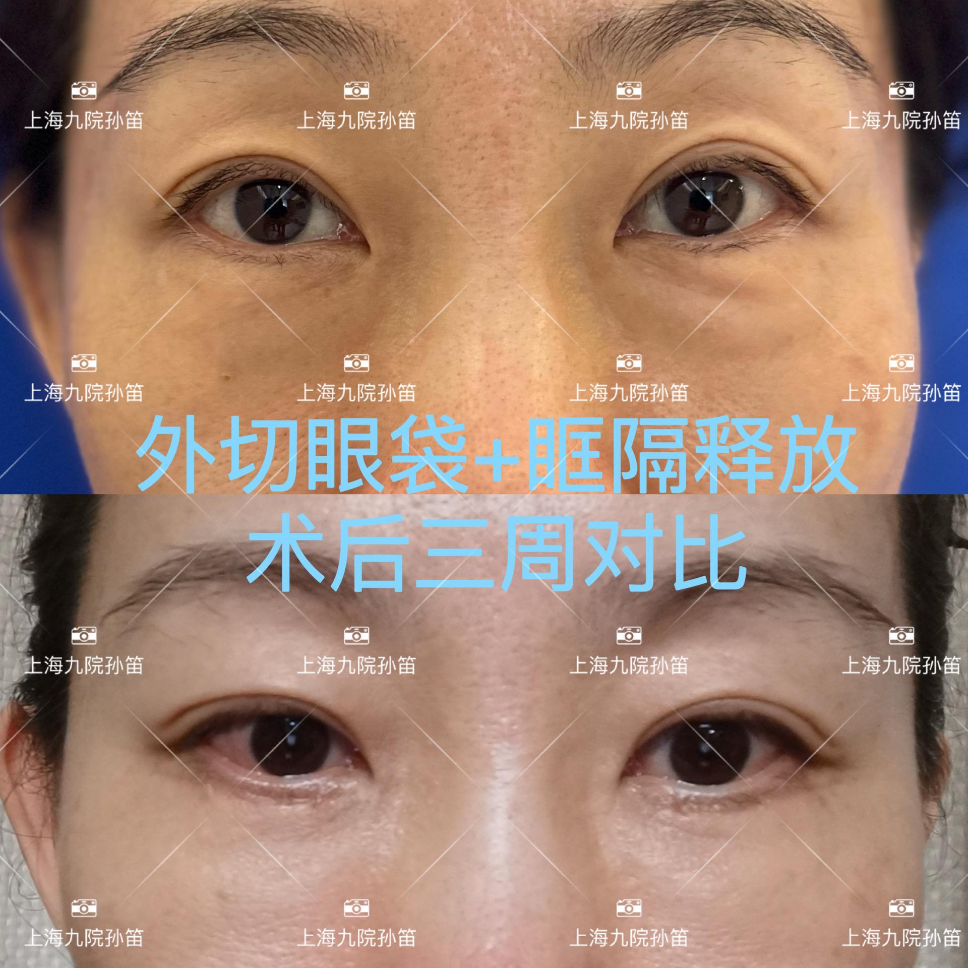 郭鑫医生眼袋手术案例二：外切眼袋去除术（下眼睑除皱）_拆线