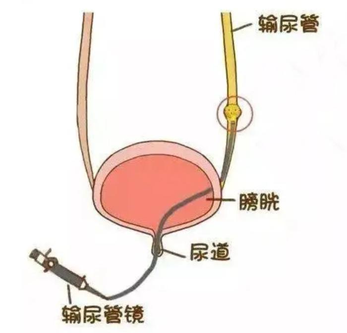 突发的无痛性血尿—叶定伟教授提醒警惕肾盂癌和输尿