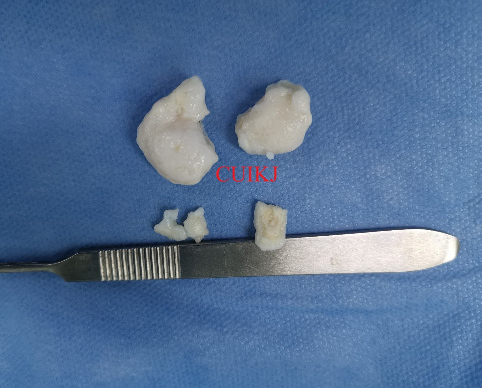 原创鼠年谈鼠骨哥崔大夫膝关节系列第二回关节鼠