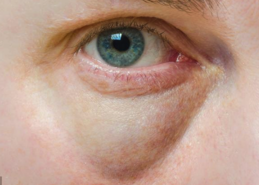 身体就会有气血不调的症状,出现尿毒症面容,导致多数患者会出现脸色发