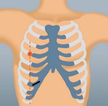 肋软骨炎怎样才能好