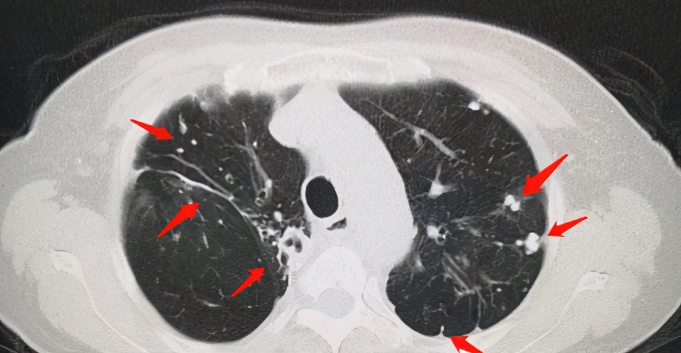 肺部增殖灶主要是由于肺结核或者肺炎好转后遗留的纤维索条影,实际上