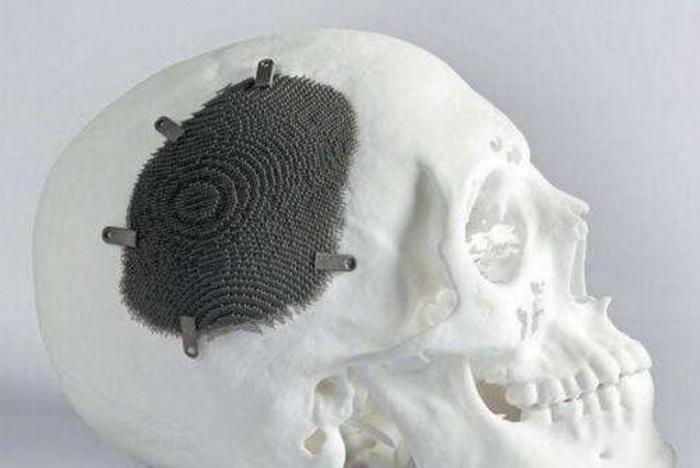 颅骨修补导致钛网外露有哪些常见因素? - 微医(挂号网)