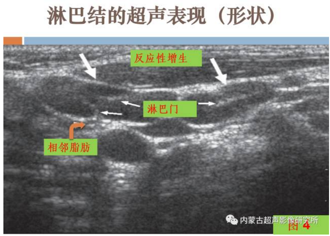 儿童颈部淋巴结超声表现