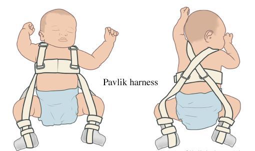 13周(3个月多一点儿)的一名婴儿,髋关节x片显示:左髋关节股骨头脱位