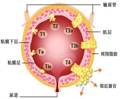 肺部腫瘤擴散能活多久不化療（肺部腫瘤擴散能活多久）