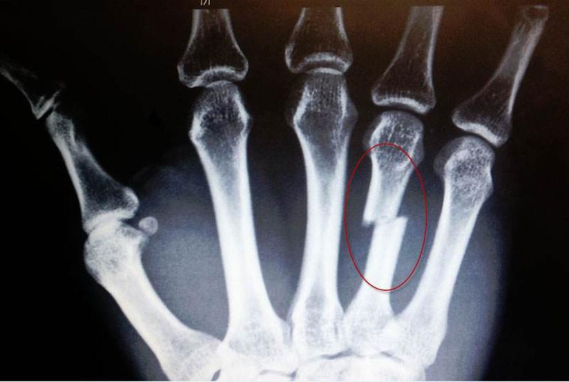 手指骨折后 一定要及早进行康复训练 健康号 微医