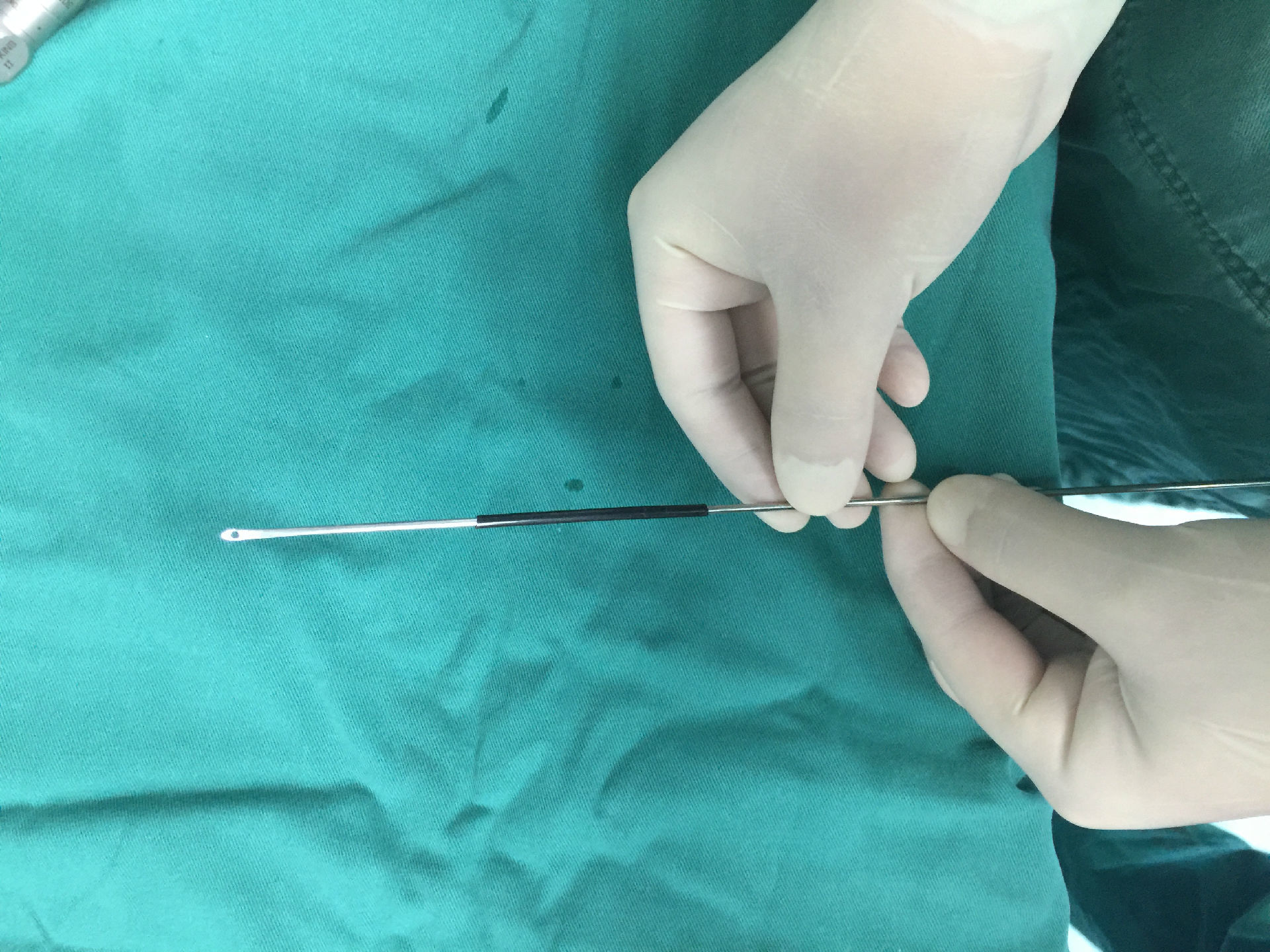 经脐正中完全单孔腹腔镜治疗小儿鞘膜积液及疝气