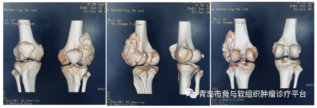 典型病例膝关节原发恶性骨肿瘤一期手术切除肿瘤型膝关节假体置换