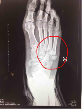 又叫jones骨折,这种骨折应该与第五跖骨的粗隆凸起鉴别,尤其在9-15岁