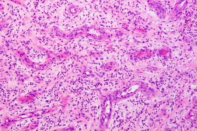 肉芽组织(granulation tissue)是新生的富含毛细血管的幼稚阶段的纤维