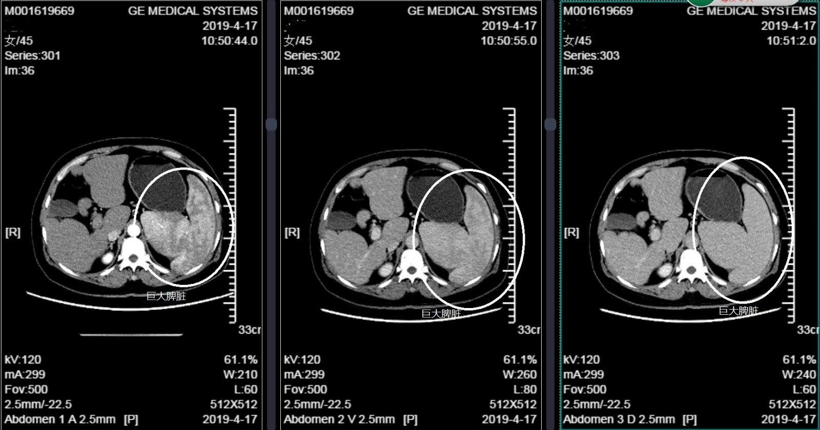 增强ct显示脾大,正常人脾脏约400g,而该患者的脾脏接近8-10斤,是一个