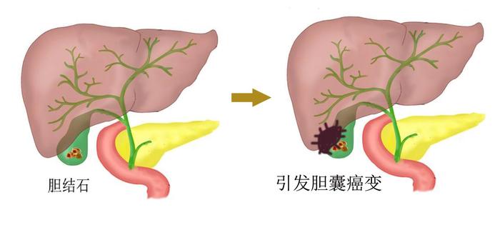 无症状胆囊结石怎么办