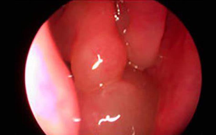 鼻息肉术后为啥会复发 健康号 微医