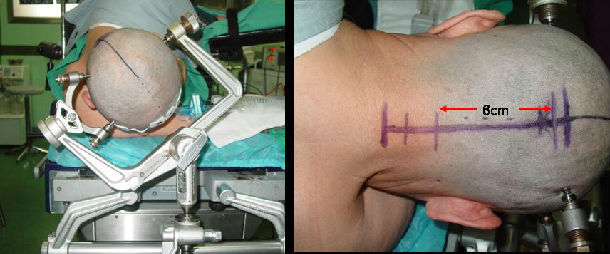 小脑扁桃体下疝畸形脊髓空洞症的手术治疗