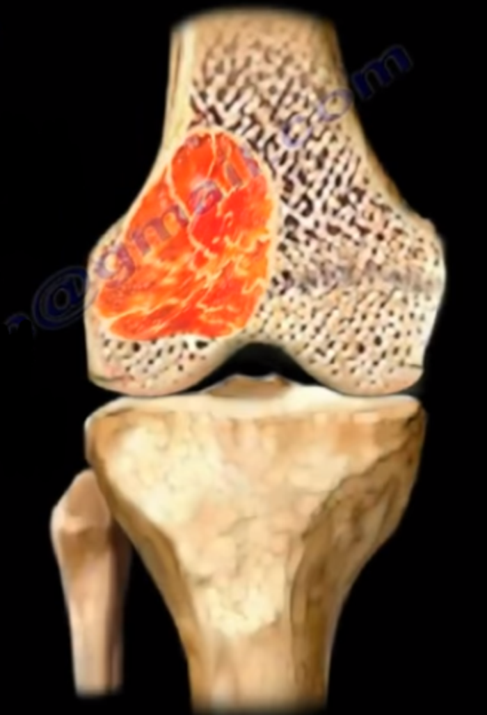 揭秘骨巨细胞瘤复发的神秘面纱十多年患者数据的惊人发现