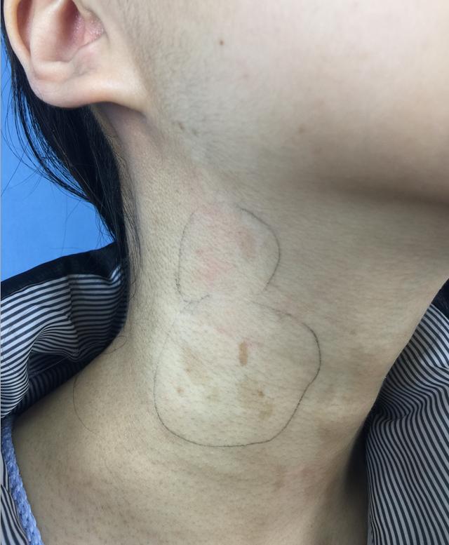 褐色胎记看上去不疼不痒危害却不容小觑!-微医