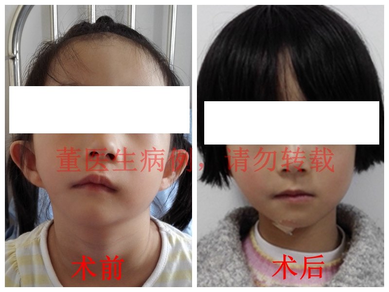 大小脸怎么办半面短小的治疗