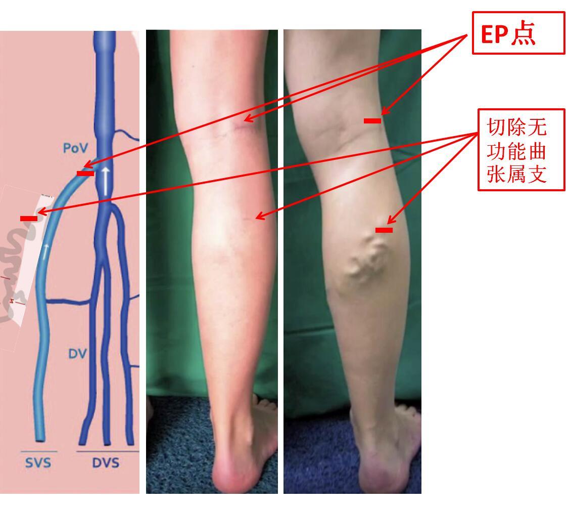 下肢静脉曲张手术图解图片