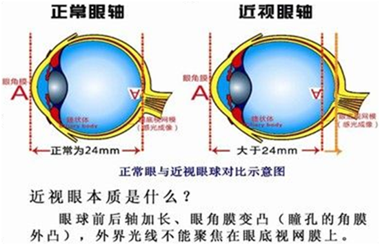 近视眼是怎么形成的