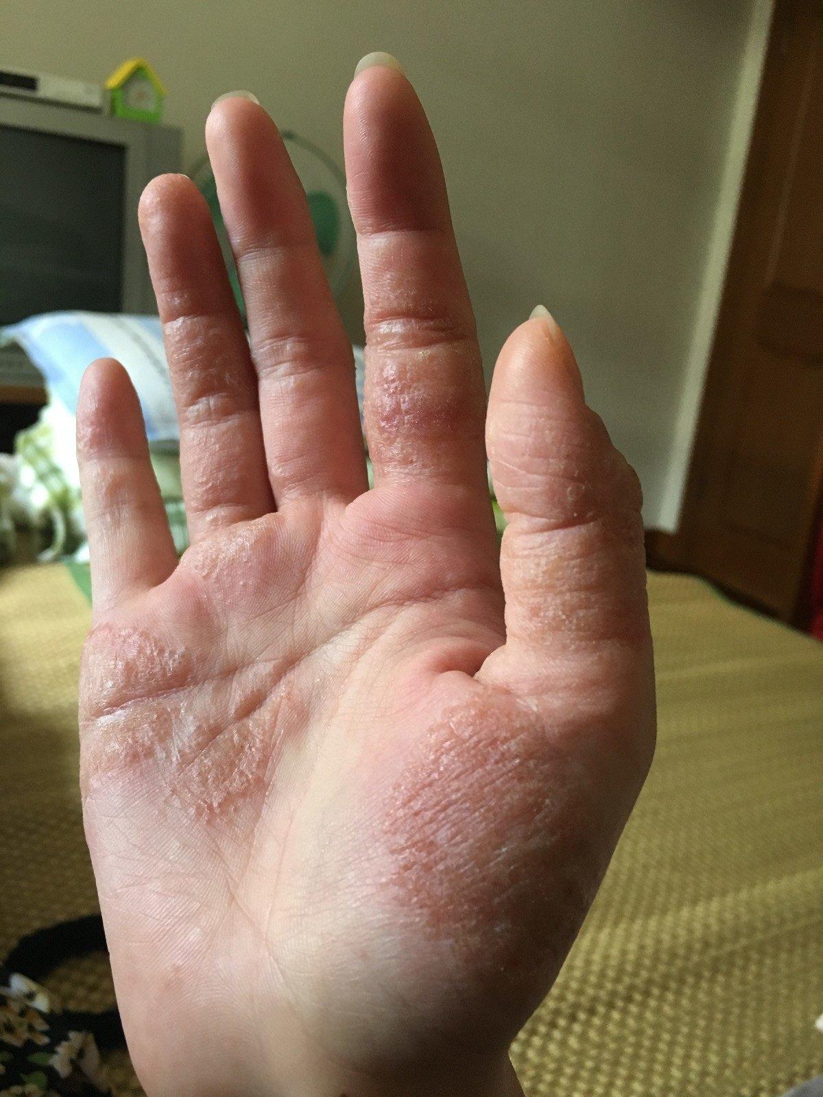 慢性顽固性湿疹诊治案例图文分享